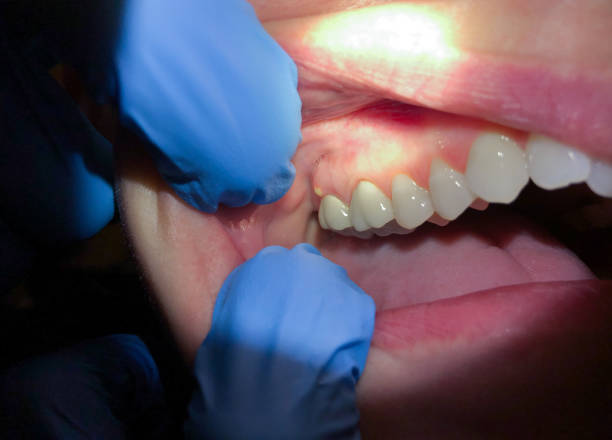 Best Emergency Treatment for Dental Infections or Abscesses in Brewster, NY